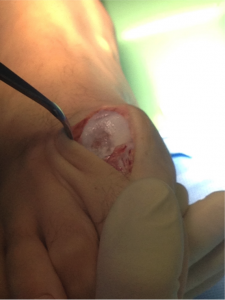 Damaged cartilage from the bone spurs