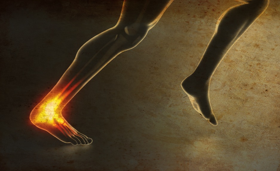 Achilles Tendonitis Tips on How to Avoid this Dreaded Injury Runner
