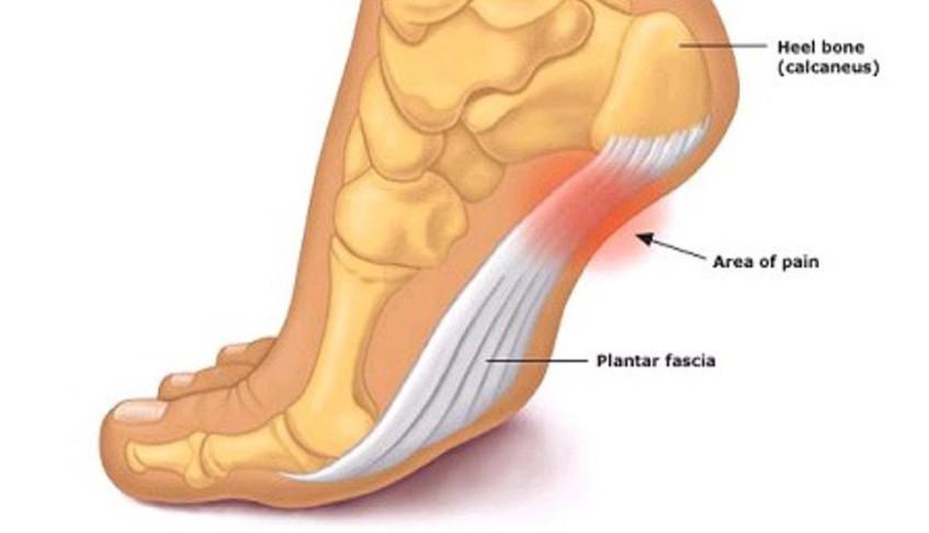 torn plantar fascia treatment